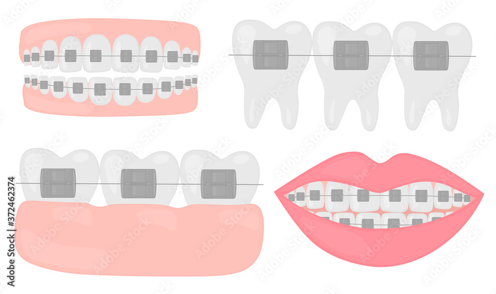 Wall mural Orthodontic set of jaws with teeth with braces vector illustration