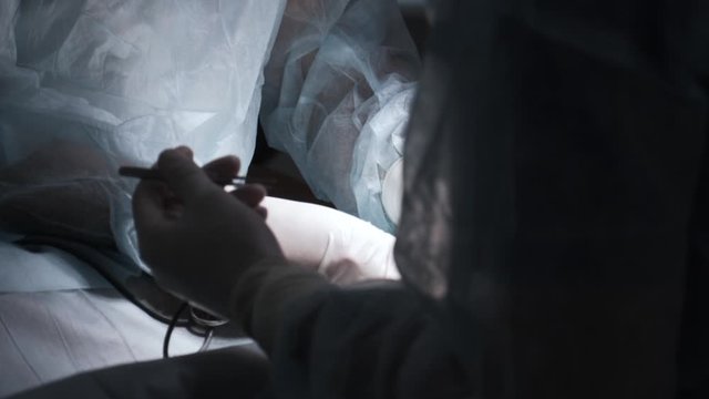 Surgeons performing operation under anesthesia. Action. Close-up surgeons open human tumor under anesthesia. Surgical treatment with correction of injuries and getting rid of diseases