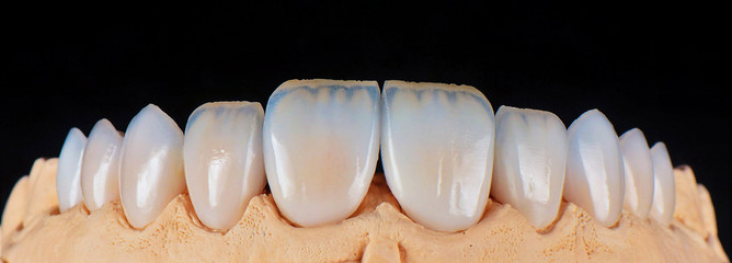 full upper jaw press ceramic veneers b1 color © Garo