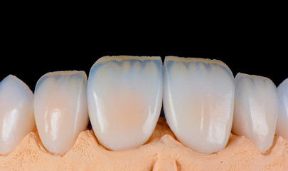 Fototapeta na wymiar full upper jaw press ceramic veneers b1 color