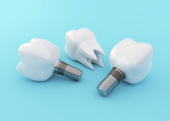 Tooth Implants and Tooth Crown on blue background, artificial teeth, dental implantation concept, 3d render