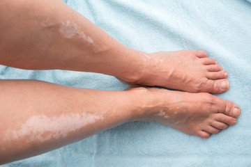 Legs (shin) of a woman, with witiligo skin condition on blue background