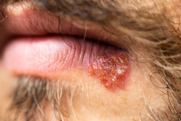 Close up shot of herpes on the lips