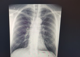 x-ray image of Human lung
