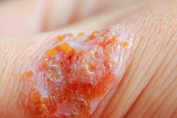 アトピー性皮膚炎が悪化して乾癬（かんせん）になった女性の手
