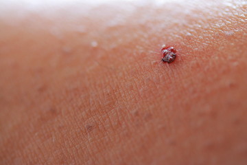 かさぶたが出来た女性の皮膚