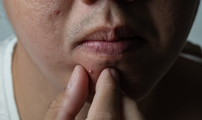 Obraz premium press acne on face, skin problem, scar and oily on face 