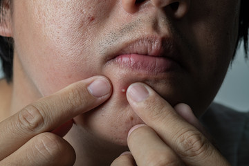 press acne on face, skin problem, scar and oily on face
