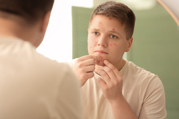 Teenage boy with acne squishing pimples near mirror