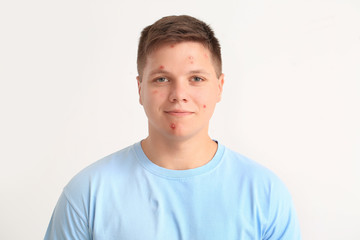 Fototapeta premium Teenage boy with acne on light background