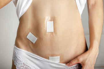 Caucasian model demonstrates Abdomen after Laparoscopic Appendix Removal Surgery