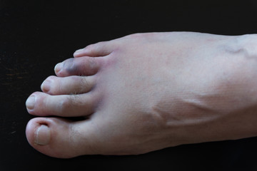 A broken male foot toe