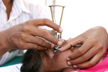 Ocular Tonometry. Eye care professionals measuring eye pressure using  Schiotz tonometer. Doctors...