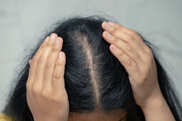 Fototapeta premium Bald woman hair loss from shampoo allergy