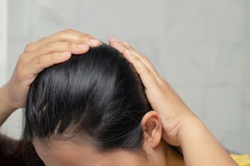 Bald woman hair loss from shampoo allergy