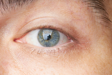 eyelid pimple macro close up. pimple near eye. hygiene problem