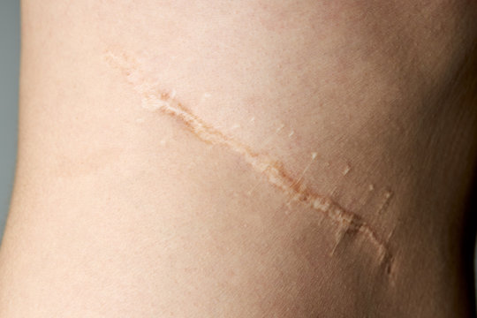 surgery scar after kidney pyelonephritis. after remove kidney operation. caucasian person close up over gray background