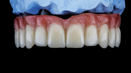 dental prosthesis for the upper jaw with artificial gum on the model, filmed on a black background © Dental Pro Content