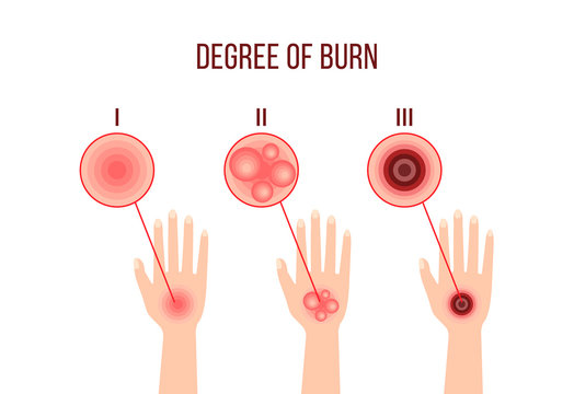 infographics of different degrees of burn