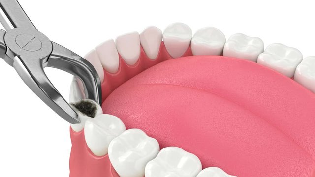 Tooth extraction by dental forceps