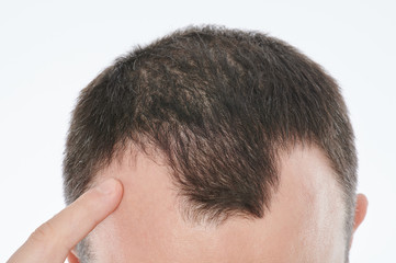 Man point to bold spot on head