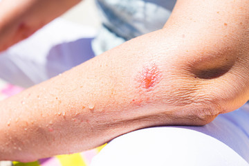 Fototapeta premium Swollen and infected red spot on woman's arm from a poison ivy rash and allergic reaction.