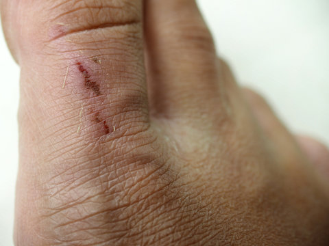 closeup abrasion wound on toe skin