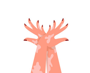 Hands of a young woman with pigmentation on the skin and a beautiful manicure on the nails. Concept: do not be ashamed of your shortcomings. Vector illustration, flat cartoon design, isolated on white