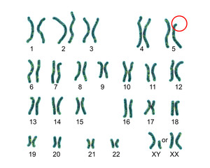 Karyotype of Cri du chat, or cat's cry, syndrome, also known as 5p- syndrome