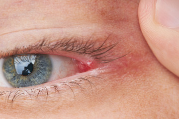 Obraz premium eyelid pimple macro close up. pimple near eye. hygiene problem