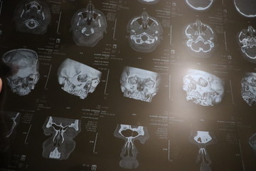 x-ray photo of patient during coronavirus pandemic
