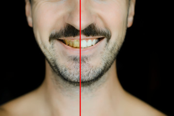 Yellow and white teeth close-up, before / after. The man shows his teeth. Concept for the use of...