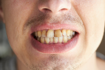 male patient mouth with tooth disease. hygiene and orthodontic problem