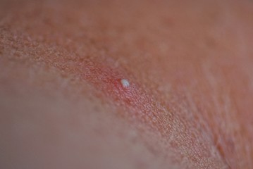 one small white pimple on the brown skin of the hand