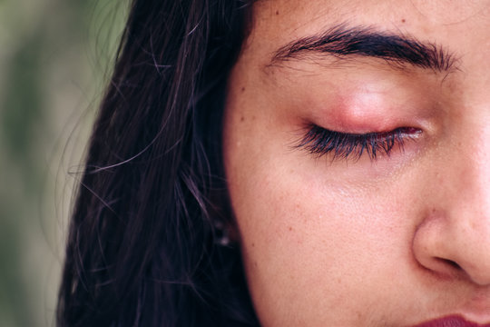 Closeup shot of Indian woman with one eye infection, upper eyelid stye with nodule. Concept of health, disease and treatment