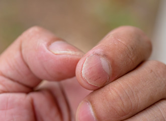 Nails having fungus disease