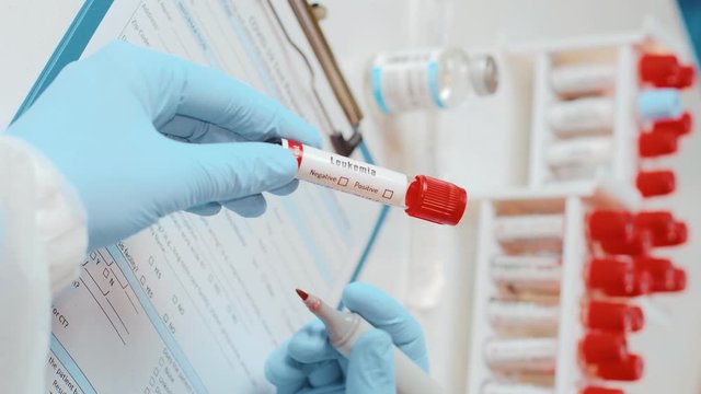 Vertical footage of doctor holds in one hand laboratory blood sample tube for leukemia cells test, other handwriting down results to patients medical record. Laboratory medical diagnostics