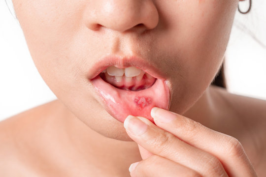 Asian women have aphthous ulcers on mouth on white background, selective focus.
