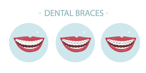 A smile with white and straight teeth with brackets. Dental service - Orthodontic treatment and straightening of teeth. Example of a mouth with different types of braces - metal, ceramic and colored. 