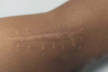 A scar is an area of fibrous tissue that replaces normal skin after an injury on skin.	
