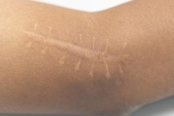 A scar is an area of fibrous tissue that replaces normal skin after an injury on skin.	
