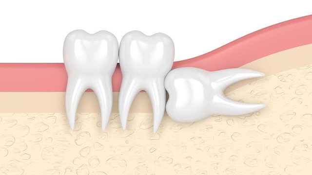 Teeth in gums with wisdom tooth horizontal impaction
