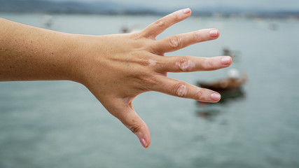 gestos de las manos con vitiligo, dedos con manchas en la piel