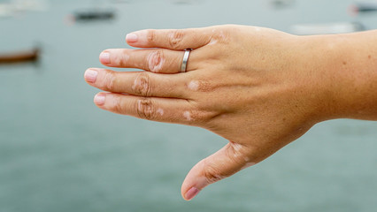 gestos de las manos con vitiligo, dedos con manchas en la piel