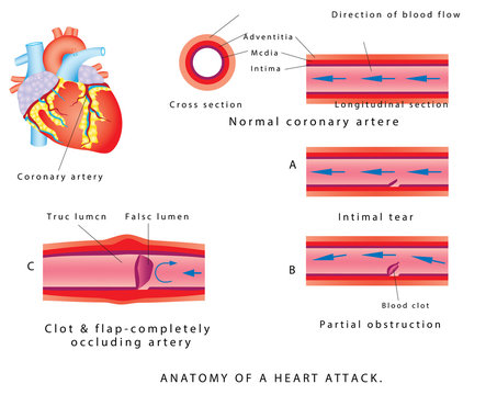 Heart attack. Anatomy of a heart attack. Heart attack and atherosclerosis. Blood vessel section with fatty deposit accumulation. Atherosclerosis progression till Stroke and Heart attack