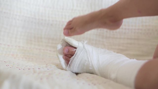 broken leg. Close-up of the cast on the feet. exercises to repair and strengthen muscles. damage to the bones. medical care of a surgeon in the emergency room