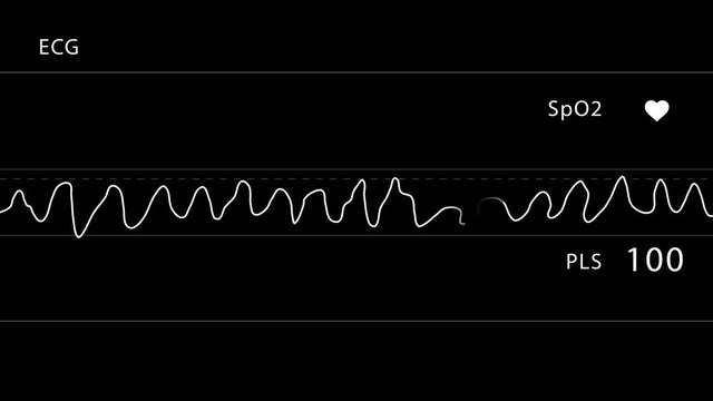 PNG Alpha.SpO2 HUD.ECG looping.Vfib.Heart rate Ventricular fibrillation.Abnormal heart rhythm.Cardiogram monitor.Technological HUD for medicine and science,Medical Institute students.Template.