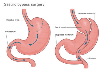 Gastric bypass surgery before and after. Vector illustration.  - obrazy, fototapety, plakaty
