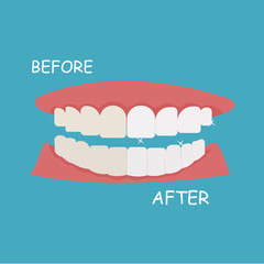 Teeth whitening.
Whitening. Vector illustration.