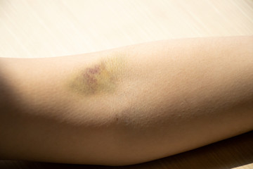 Bruise injury on the female arm background
